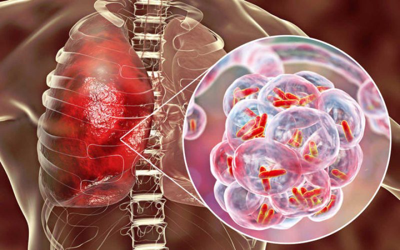 Tuberculosis Doctor in East Delhi